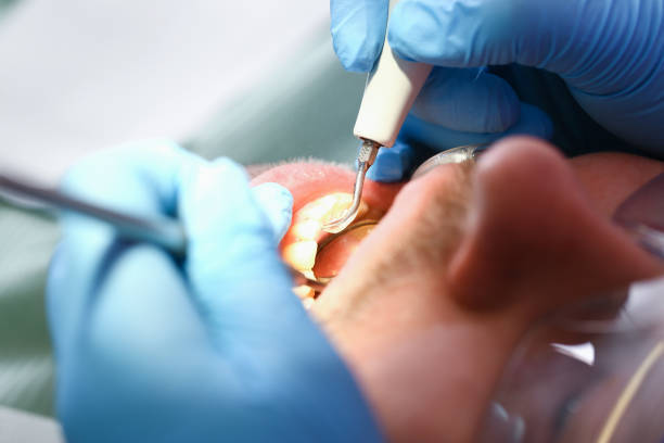 Best Emergency Root Canal Treatment in The Village, OK
